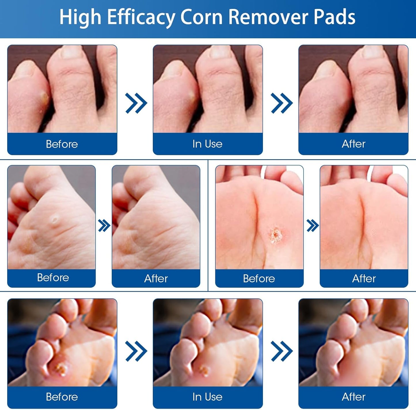 24 Count Corn Removal Pads for Feet and Toe, Corn Feet Remover for Feet Extra Strength, Callous Remover